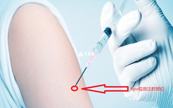 hpv疫苗注射哪个部位