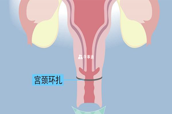 宫颈环扎术适用于孕早期