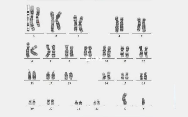 染色体检查结果怎么看