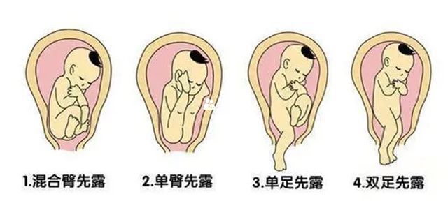 图解三种胎位