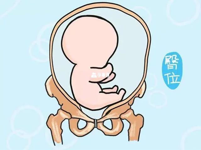 孕期胎儿臀位