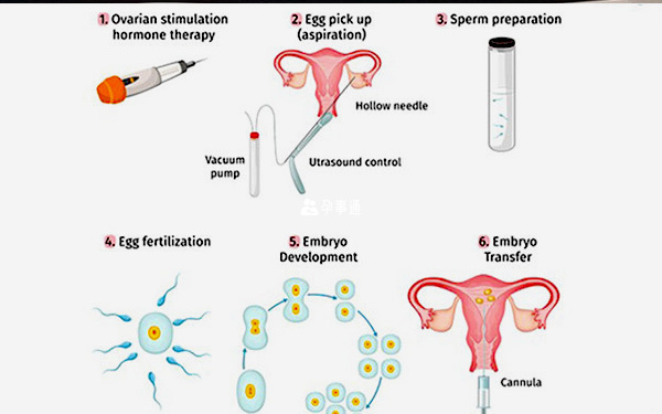 夫精人工授精流程图