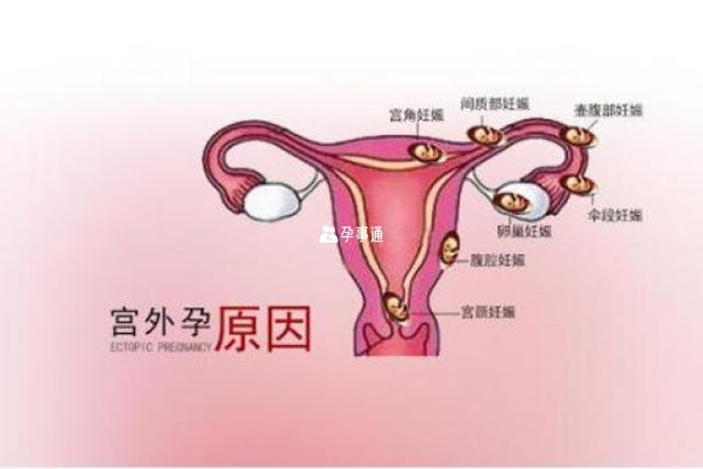 得宫外孕的6种病因