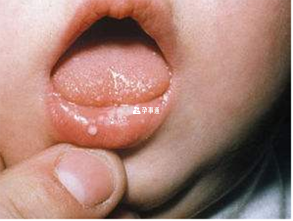 无症状感染多发生在幼儿
