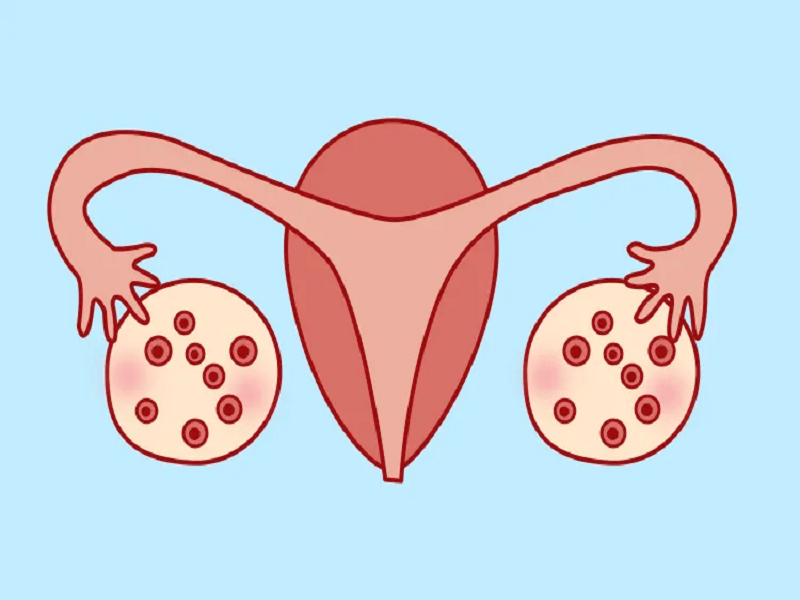 多囊卵巢最快受孕方法