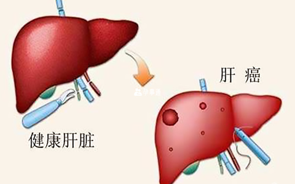 甲胎蛋白的临床意义