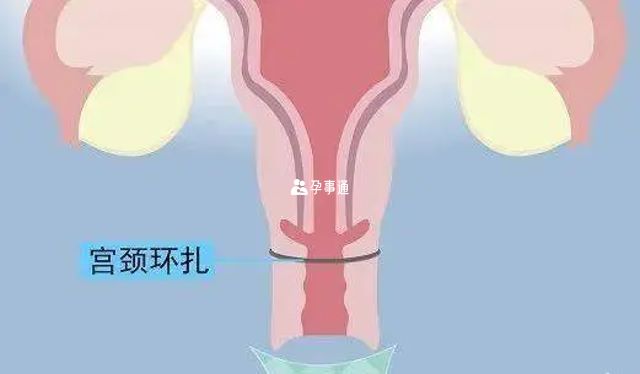宫颈环扎类型