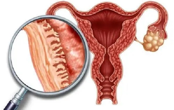 子宫内膜厚度在月经期被分为3个期