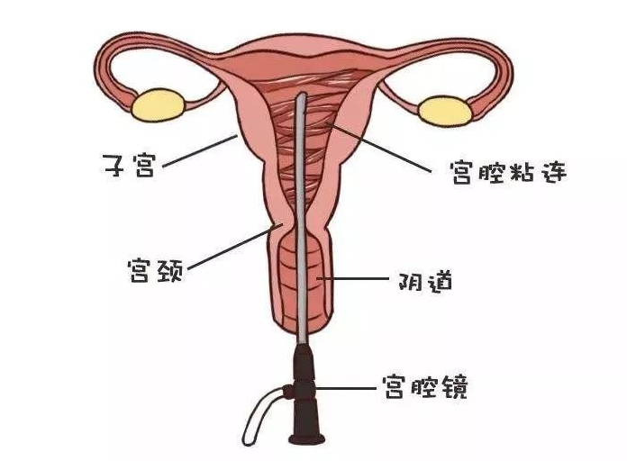 宫腔镜检查