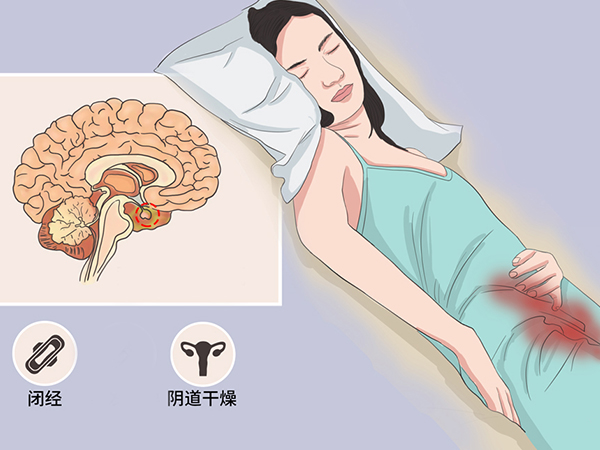 乙烯雌酚对女性外阴干枯症有作用