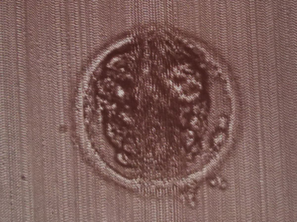 空囊与囊胚染色体异常有关