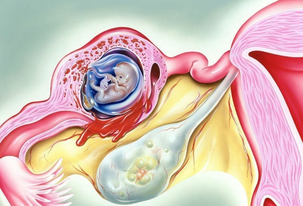 宫外孕一般是在怀孕40天到50天做b超检查出来