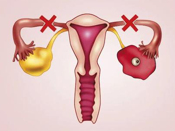 输卵管堵塞试管移植后不会宫外孕
