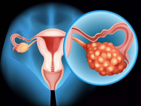 多囊卵巢患者使用拮抗剂方案能减轻对卵巢的刺激
