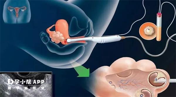 取卵手术全过程