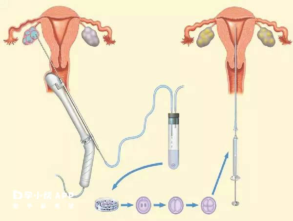 取卵针取卵过程图