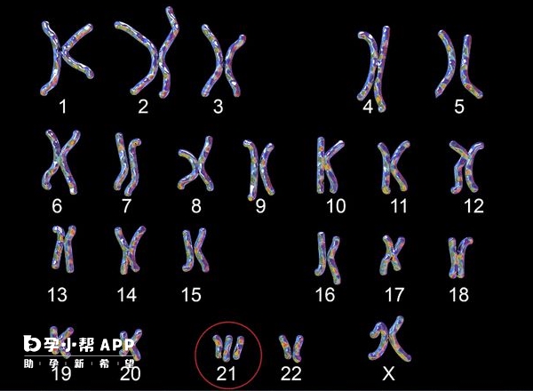 染色体异常会遗传疾病