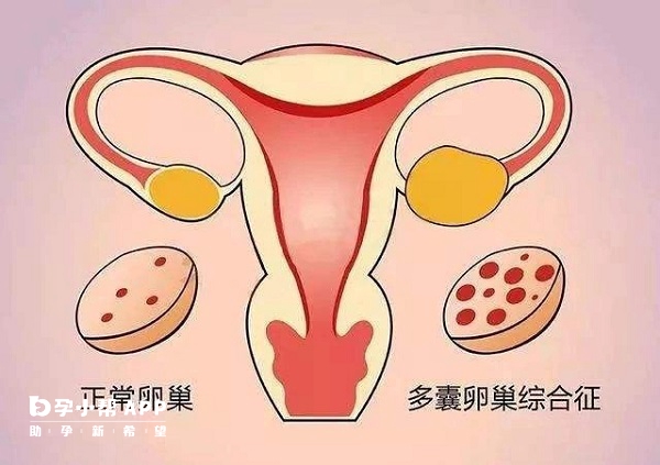 多囊吃麒麟丸没有治疗效果