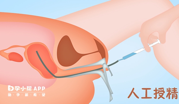 人工授精手术