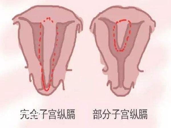 纵隔子宫怀孕易流产