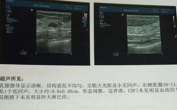 女性乳腺彩超多久一次根据情况而改变