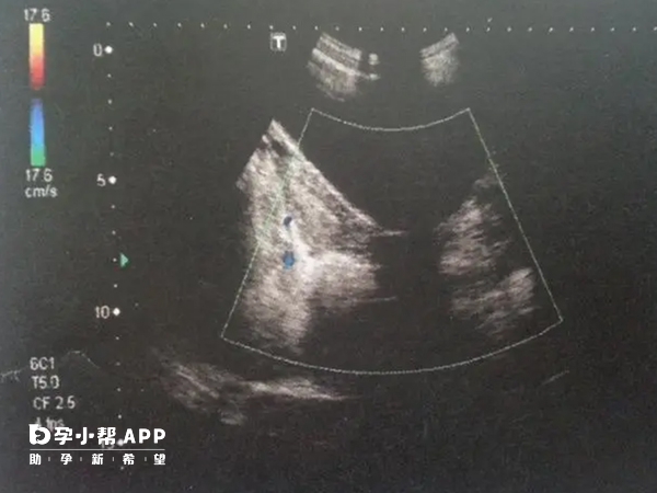 弓形子宫与纵隔子宫都是子宫畸形的一种