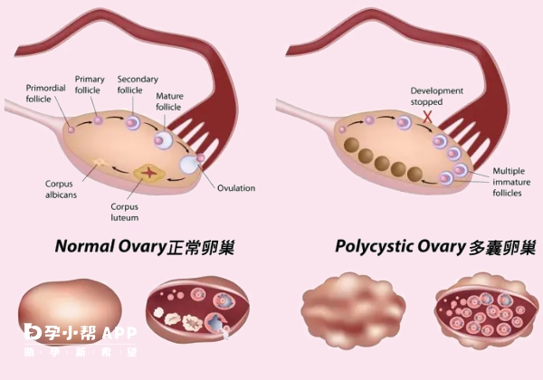 多囊卵巢会导致月经紊乱