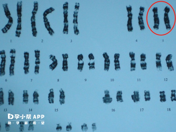 5号染色体异常会导致智力障碍