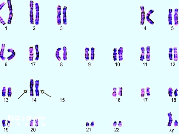 14号染色体异常可能会致癌