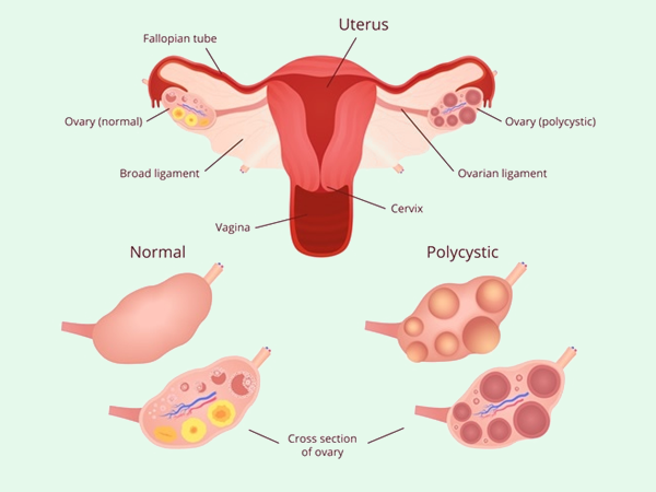 多囊卵巢会导致不孕不育