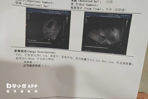 大部分女性移植28天宝宝有胎芽