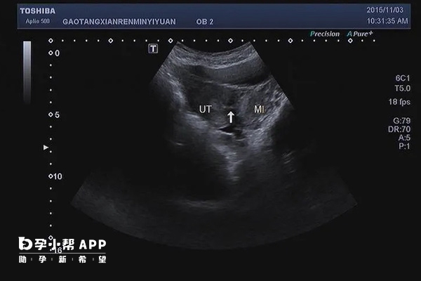 B超单角子宫影像