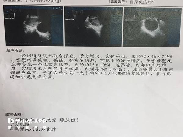 巧克力囊肿可保守治疗