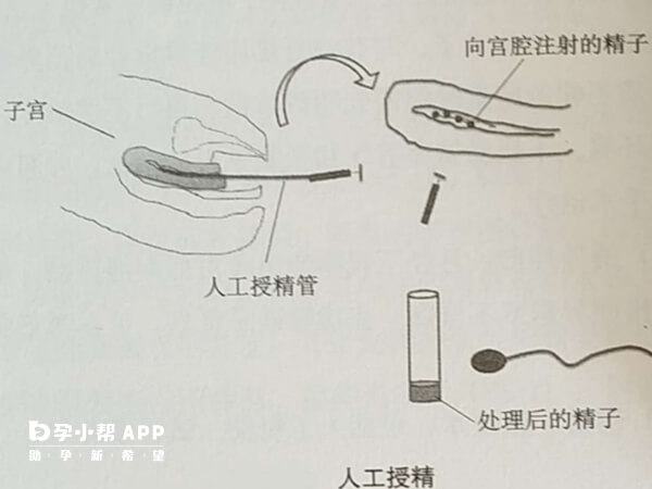 人工授精手术过程