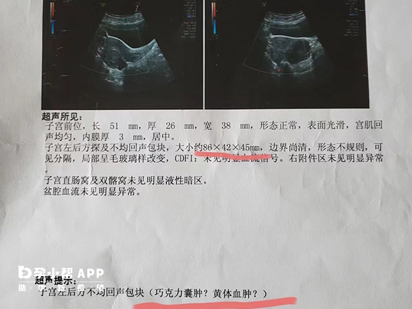 剖腹产切除囊肿有出血风险