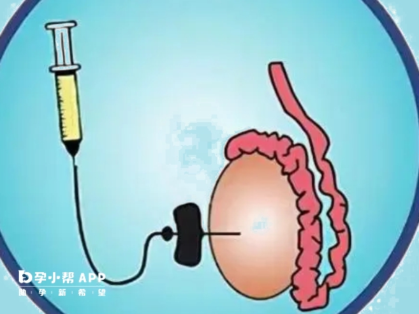 穿刺取精是在睾丸中获取精子