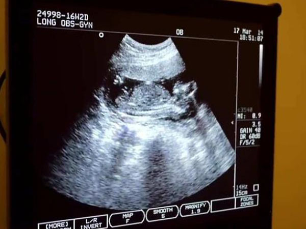 胎儿越大是不是不好检查男女
