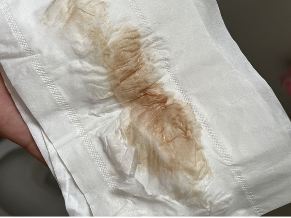 试管移植鲜胚后出血是怎么回事