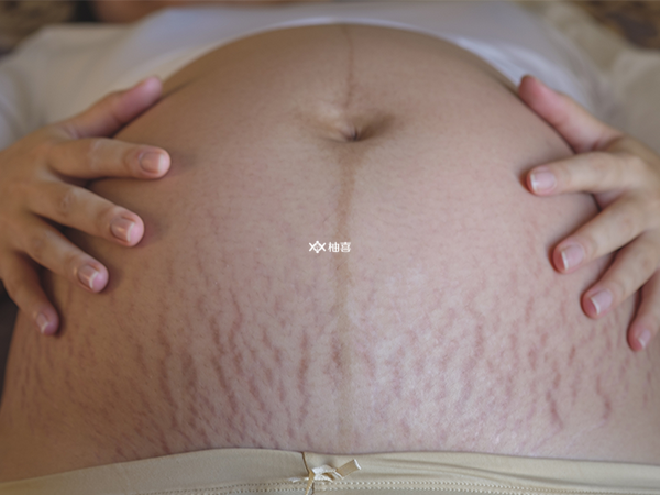 生女儿的妊娠线图片