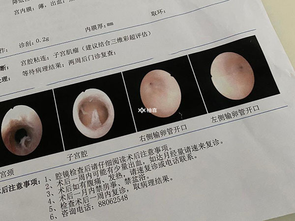 成都华西医院宫腔镜检查多少钱