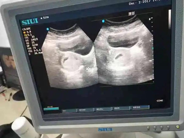 医生暗示双胞胎性别是什么话