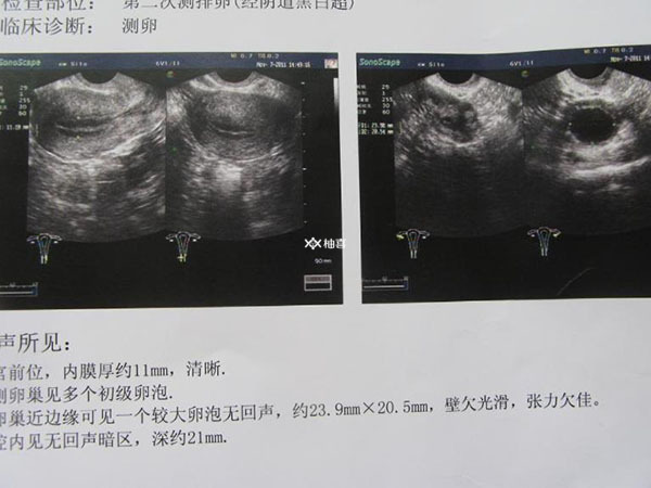 促排第15天卵泡较小正不正常