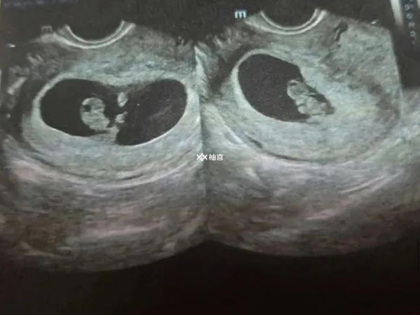 怎么利用孕囊看胎儿是男是女