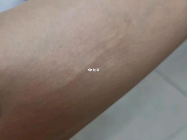 皮埋避孕恢复好是什么感觉