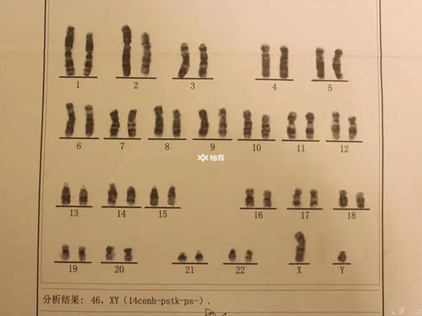 8号染色体三体发生的几率是多少