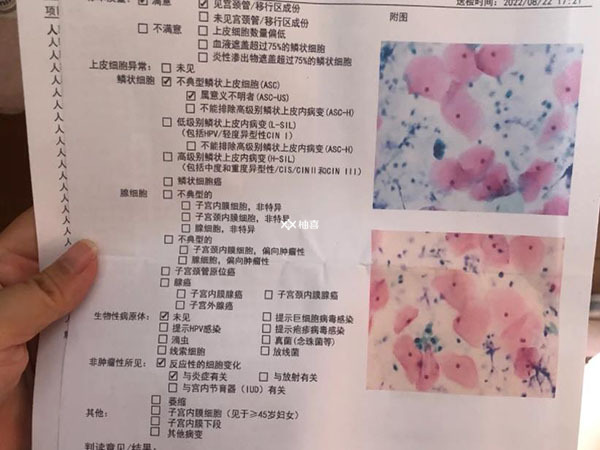 tct正常报告什么样子