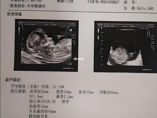 nt值4.6出生后要怎么做