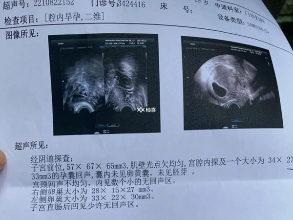 移植2个鲜胚只找到1个是什么情况