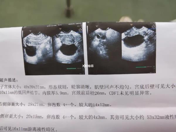 打果纳芬5天卵泡多少正常