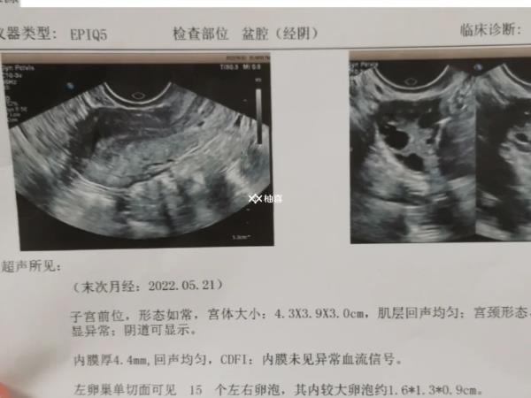 打促排卵针长了12个卵正不正常